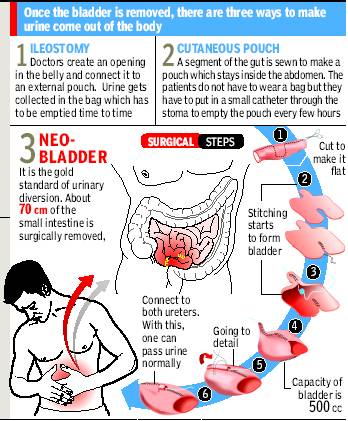  New hope & a Unique surgical approach for Bladder Cancer Patients