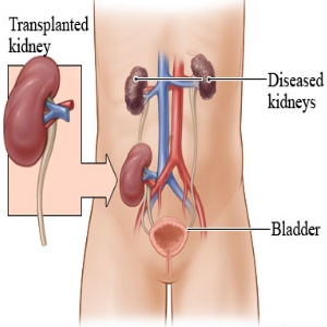  World Class Kidney Transplant Surgery in India – Success Factors for Excellent Outcomes in Indian Hospitals