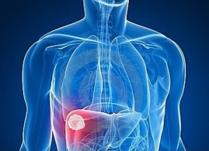  Nonsurgical Treatments for Liver Cancer at World Class Hospitals in India