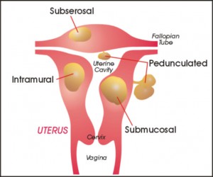  Non-Surgical Cure for Uterine fibroids at World Class Hospitals in India