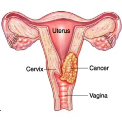  Low-cost screening for cervical cancer in India