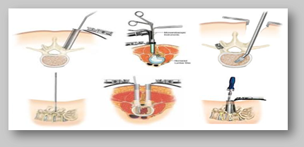  Types of Minimally Invasive Spine Surgery at World Class Hospitals in India