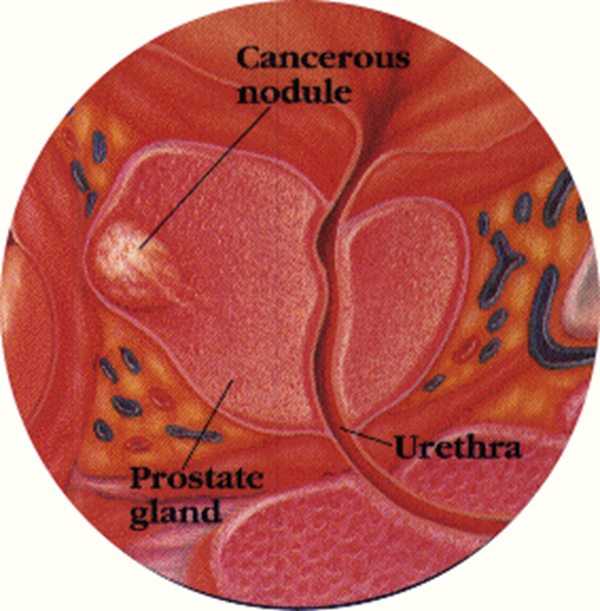 a prosztata fibrózis prosztatitis