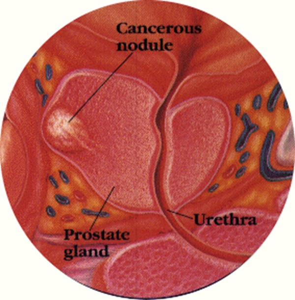 Prostatetis calcenoid Adenom de prostata simptome si tratament