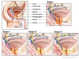 is there a stage 5 prostate cancer