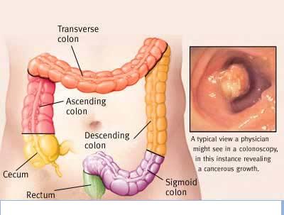  Colorectal cancer is sometimes called a silent killer – Treatment Options available for Colon Cancer at Top Cancer Hospitals in India