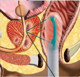  Non Surgical HIFU High Intensity Frequency Ultrasound Treatment for Prostate Cancer