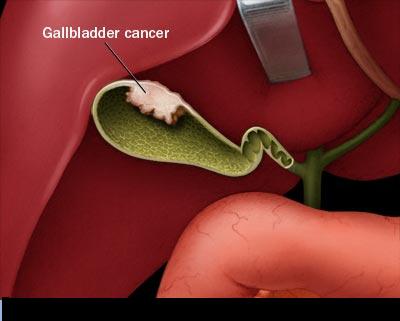  World’s Most Advanced Robotic Surgery for Gallbladder Cancer in India