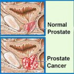  How to lower your chances of suffering from Prostate Cancer