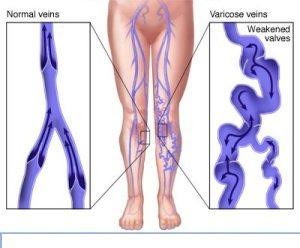  Modern Non-Surgical Treatment for Varicose Veins in India