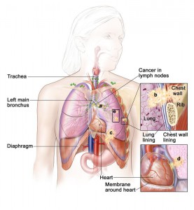  Can non-small cell lung cancer be found early? and how is non-small cell lung cancer diagnosed ?