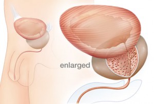  Non-Surgical Treatment for Enlarged Prostate at World Class Hospitals in India