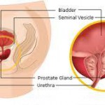  Prostate Cancer Treatment – Da Vinci Robotic Surgery in India