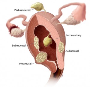  Fibroids Common  Signs & Symptoms and What are the Treatments For Fibroids?