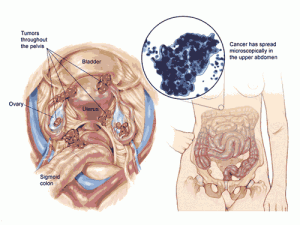  Most ovarian cancer tumours are present for some time before they’re diagnosed. -Diagnosing ovarian cancer