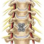  Cervical Disc Replacement Surgery in India