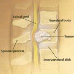 Common types of spinal tumors that can cause Back pain