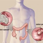  Colorectal Cancer Testing Needs to Increase among over 50