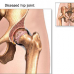  When Hip Replacement Surgery is Required?