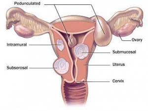  Fibroids Treatment- No Surgery, Quick Recovery