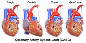  Coronary Artery Bypass Surgery – Cardiac Surgery in India