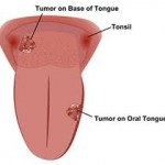  Laser Surgery for Oral Cancer in India