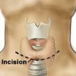  Highly Advanced Minimally Invasive Surgical Treatment for Thyroid