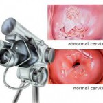  Survival rates for Cervical Cancer by Stage