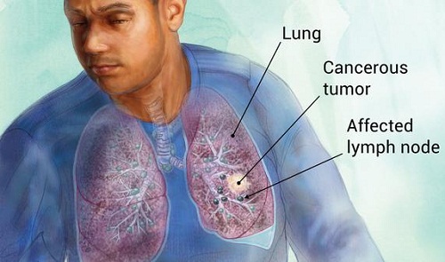 lung cancer