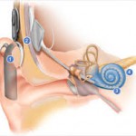  Who is an Eligible Candidate for Cochlear Implant Surgery?