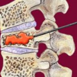  An Advanced Treatment for Spinal Osteoporosis in India
