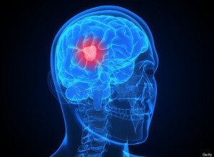  Advanced Non Surgical Treatment for Brain Tumors