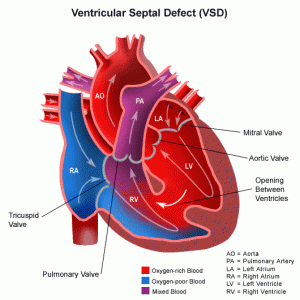 Congenital Heart Defects in children.
