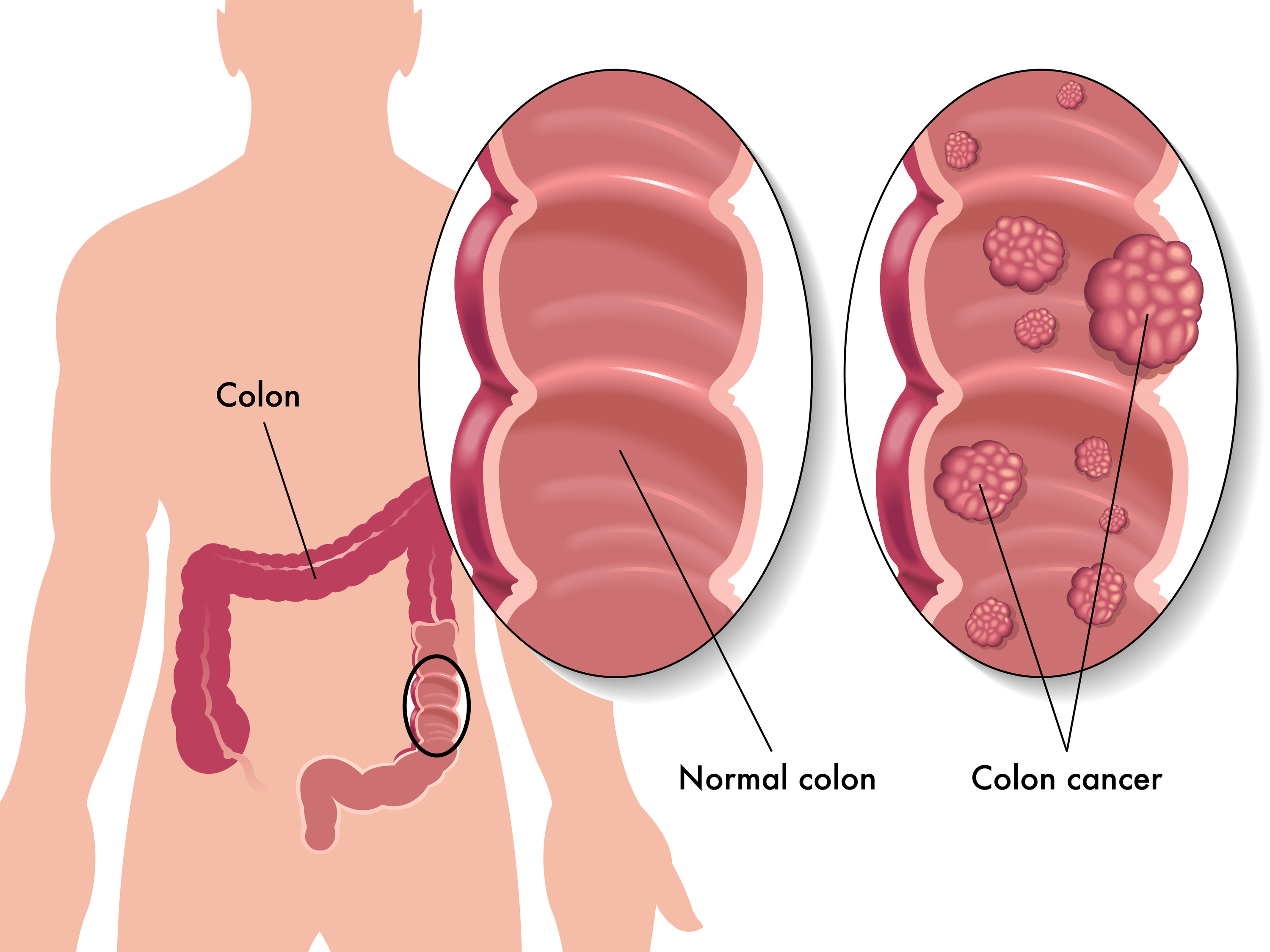 colon-cancer-treatment-from-best-hospitals-in-india