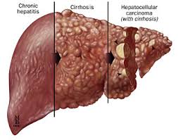  Hepatitis C, Life Threatening if not Diagnosed and Treated