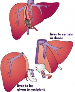 liver-transplant-surgery-in-india
