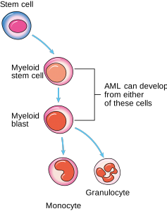 Acute-myeloid-leukemia
