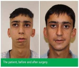  Afghan Man’s ‘Bird Face Deformity’ Successfully Treated By Doctors At Safemedtrip Affiliated  World Class Hospital In India