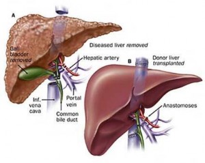 liver_transplant