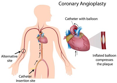 angioplasty