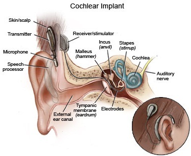 Advanced Bone Conduction Cochlear Implant Ent Treatment In India Safemedtrip