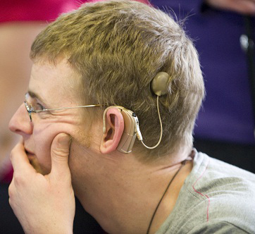 cochlear-implants