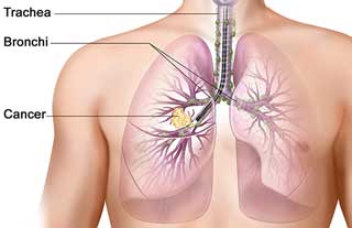 health-lung-cancer