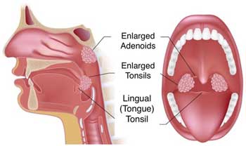  New Breakthrough treatment for swollen tonsils now available in India.