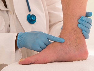 varicose veins