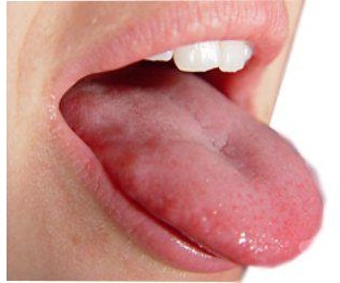  Miraculous surgery saves Oral Cancer patient, Indian Surgeons reconstruct tongue with flesh from thigh.