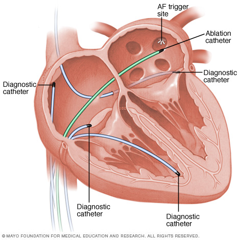 radiofrequency-catheter-ablation