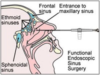 Endoscopic Sinus Surgery FESS