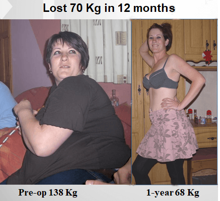 Bariatric Weight loss