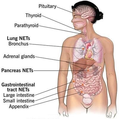 PRRT Nuclear Therapy